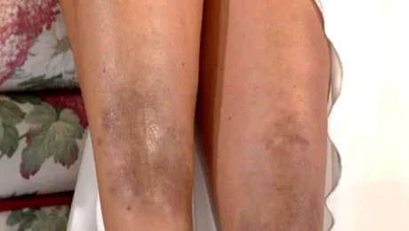 Bianca Drăgușanu, cu picioarele pline de vânătai!