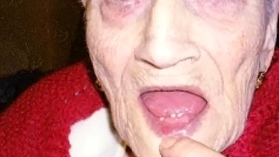 Unei femei de 97 de ani îi cresc din nou dinții