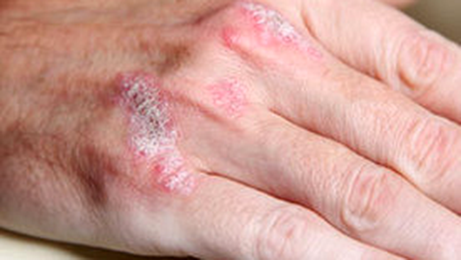 Psoriazis