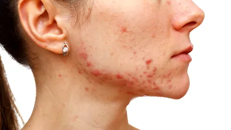 Mască cu usturoi pentru acnee