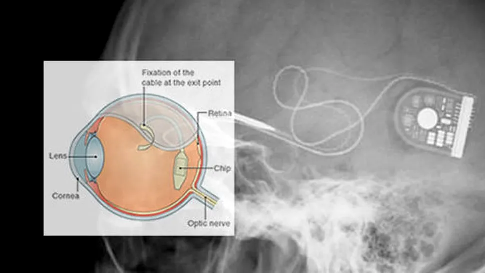 Implanturi cu senzori foto pe post de ochi, pentru orbi