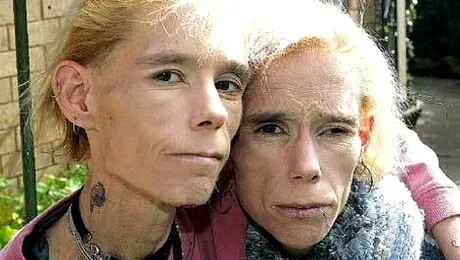 Gemenele anorexice din Australia au murit într-un incendiu