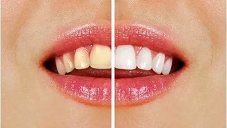 Cum să-ți albești singur dinții, acasă