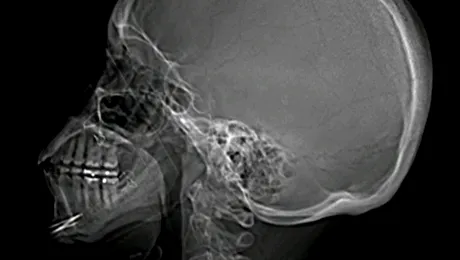 Cum a ajuns un cui de 8 cm in capul unui barbat