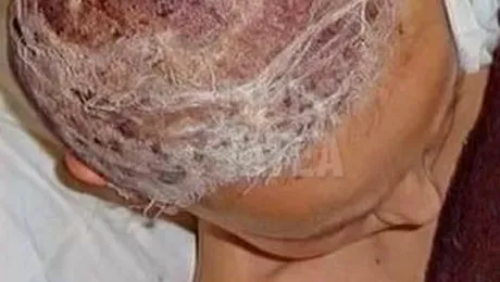 O fetita a luat foc pe masa de operatii