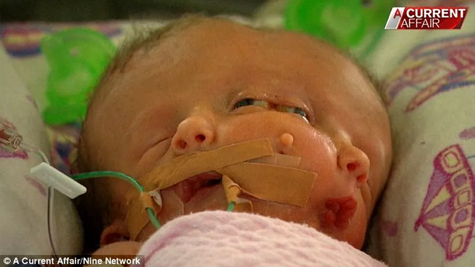 În Australia s-a născut copilul cu două fețe