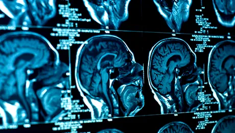 A fost identificată regiunea cerebrală responsabilă de instalarea schizofreniei și bolii Alzheimer