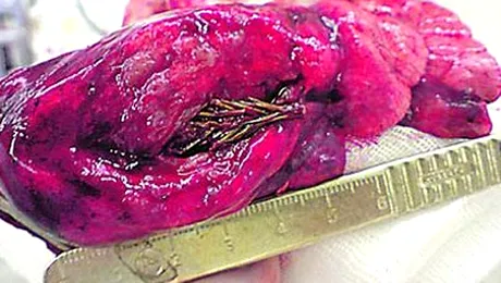 Un barbat din Rusia a trait cu un molid in plaman