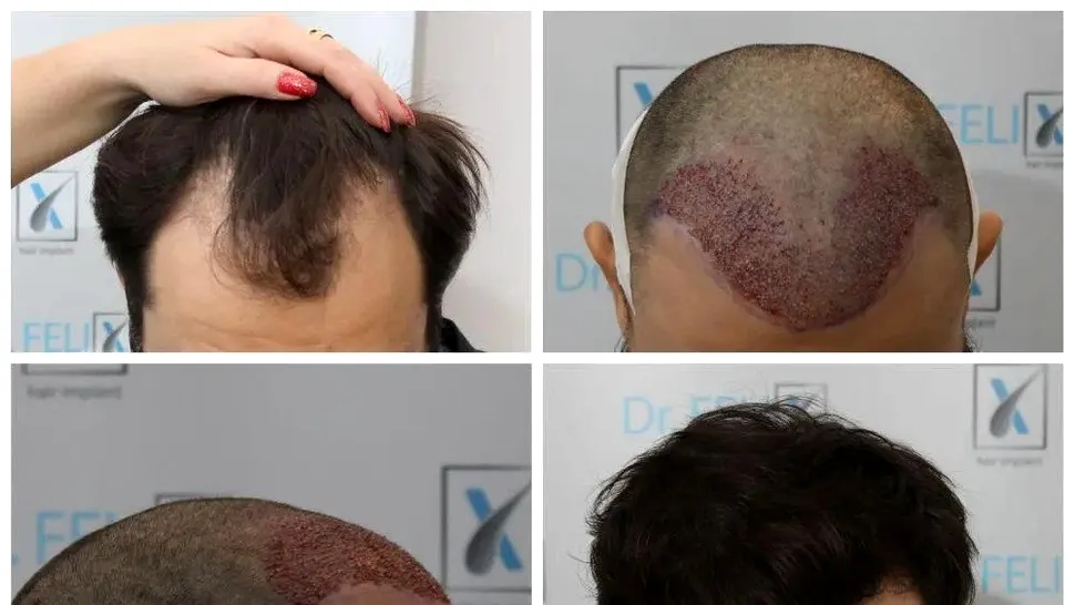 De ce este atât de popular transplantul de păr prin tehnica Q-FUE? (P)