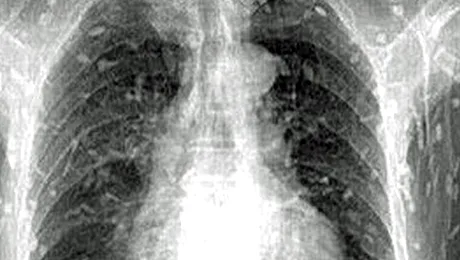 I s-a umplut corpul de tenii, după ce a mâncat pește contaminat