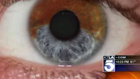 O noua interventie laser schimba ochii caprui in albastri