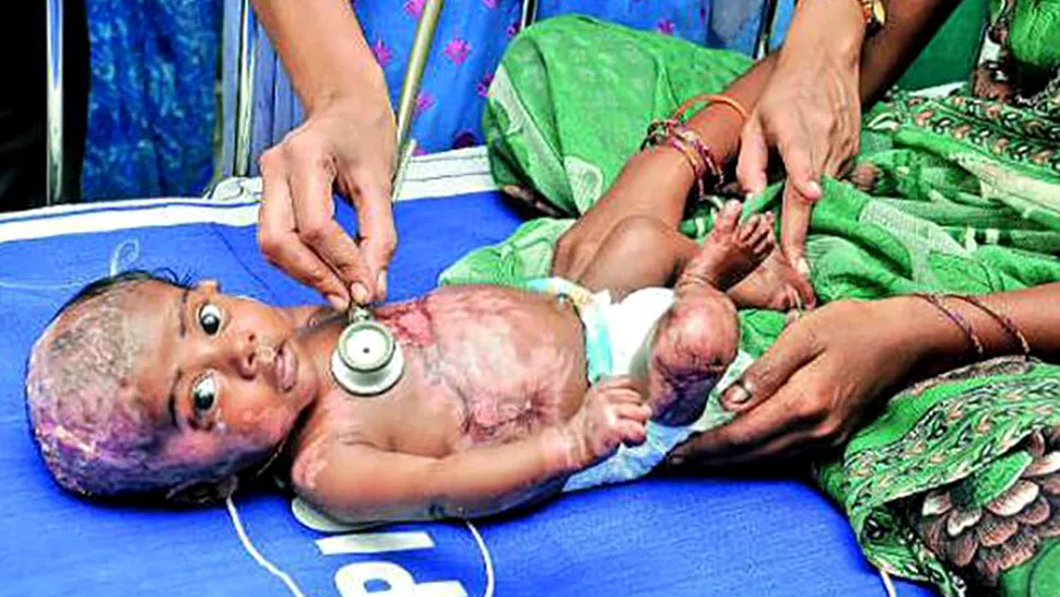 Un nou născut indian suferă de Combustie umană spontană