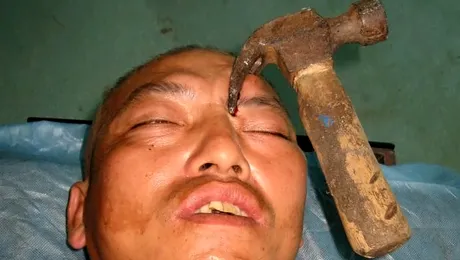 Un muncitor a supravietuit dupa ce un ciocan i-a strapuns craniul