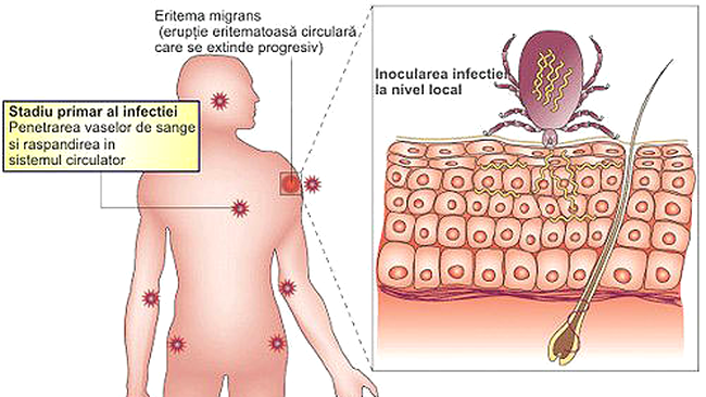 Boala Lyme (sau borelioza) este provocată de căpușe