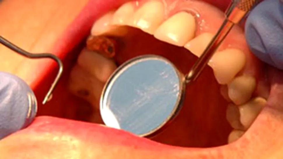 Implantul dentar, o 