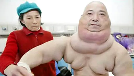 Topul celor mai oribile tumori (Poze)