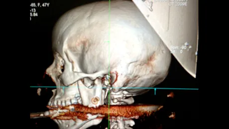 O femeie a supraviețuit după ce a fost împușcată cu un harpon