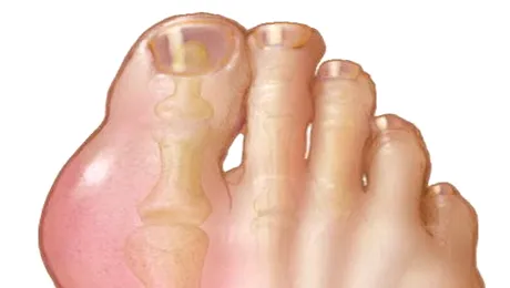 Care sunt cauzele gutei