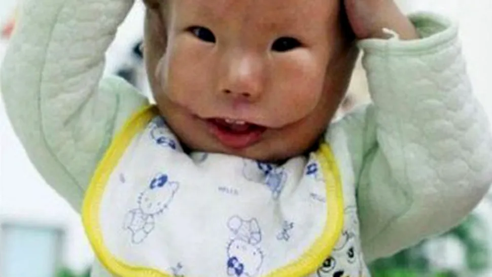 Bebelus nascut cu masca din propria piele pe fata