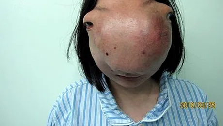 A fost poreclita „Fata Avatar”, din cauza unei tumori