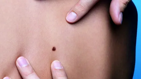 Verificaţi-vă aluniţele! Metodă la îndemână de autoevaluare – FOTO