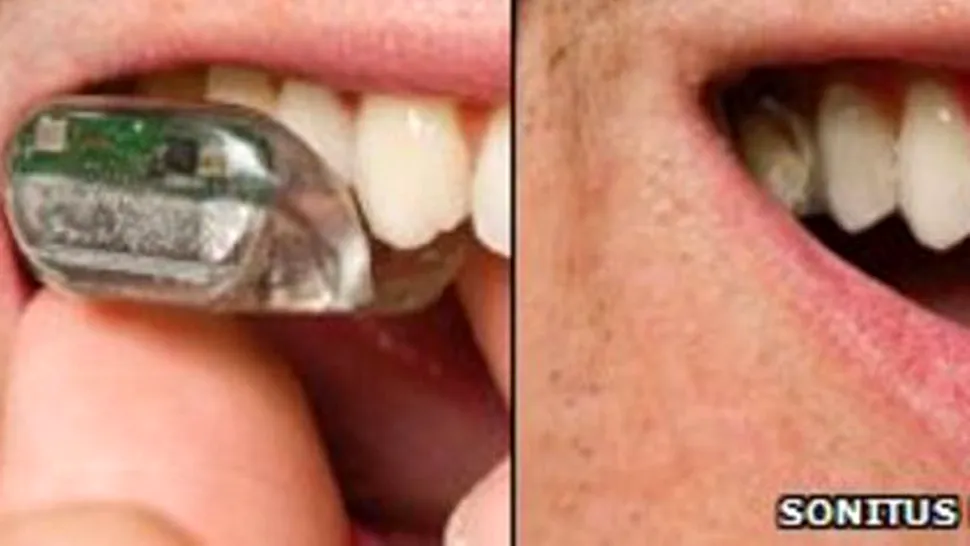 Europa a autorizat aparatul auditiv implantat in dinte