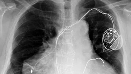 Un barbat cu doua inimi a supravietuit in urma unui dublu infarct