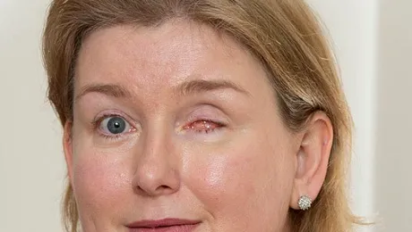 Și-a pierdut un ochi din cauza lentilelor de contact