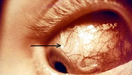 Și-a pierdut vederea în urma unei infecții cauzate de fecalele de câine