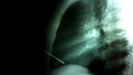 Un bărbat a supraviețuit unui cui înfipt în inimă