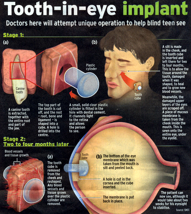 stadii implant dinte in ochi