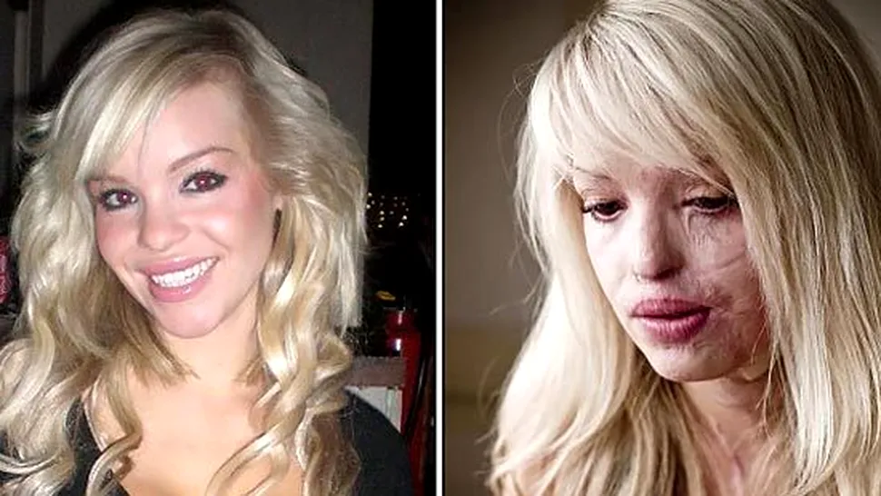 Katie Piper, tanara desfigurata cu acid, a pozat pentru revista Reveal