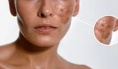 (P) Melasma: de ce apar petele maronii, cum le tratăm și cum le prevenim