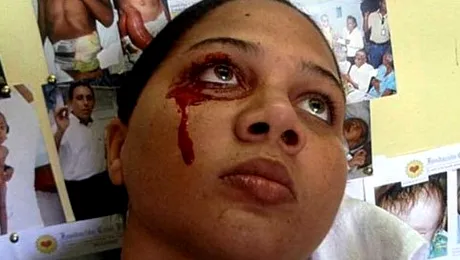 Boala de care suferă o face să plângă și să transpire sânge