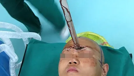 Un adolescent a supravietuit dupa ce o sabie i-a strapuns craniul