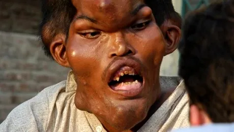 Frankenstein traieste: Iata omul cu chip de monstru! (Foto si Video)