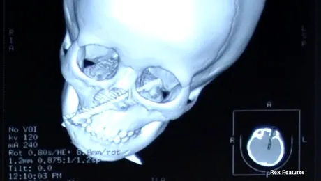 O fetiță a supraviețuit după ce i-a intrat o ȘURUBELNIȚĂ‚ în față!