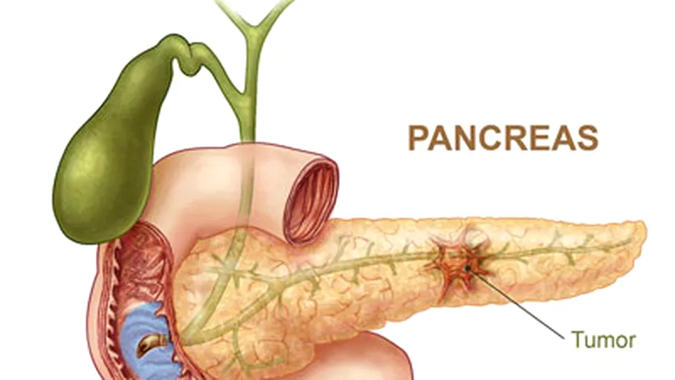 Ce este cancerul pancreatic, boala ce l-a ucis pe Patrick Swayze