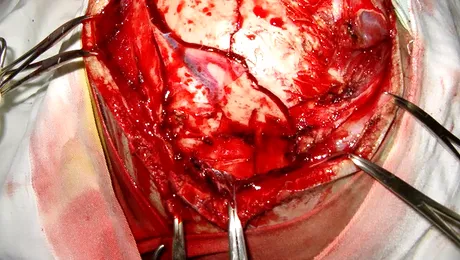 A supravietuit dupa ce o bara de otel i-a strapuns craniul