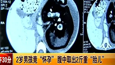 Un băiat de 2 ani și-a născut propriul frate