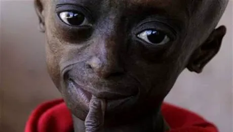 Ea este singura fetita de culoare care sufera de boala „copiilor batrani”