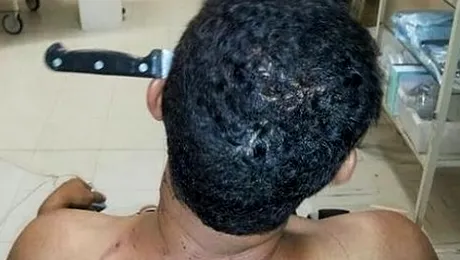 A venit singur la spital… cu un cuțit înfipt în cap!