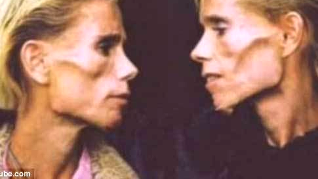 Gemenele anorexice din Australia 