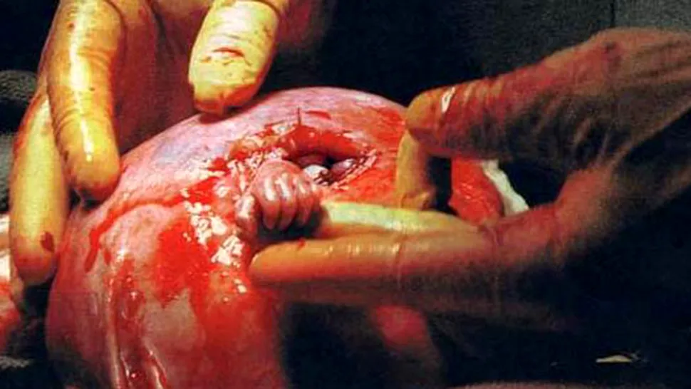 Samuel, faimosul bebelus care a scos mana din uterul mamei (Foto)