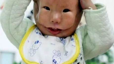 Bebelus nascut cu masca din propria piele pe fata