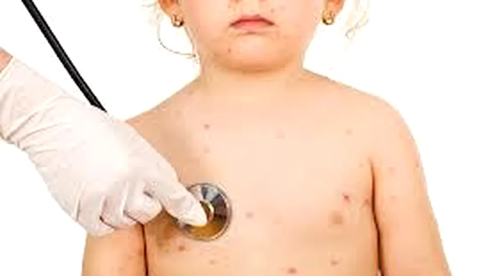 De ce fac copiii varicelă