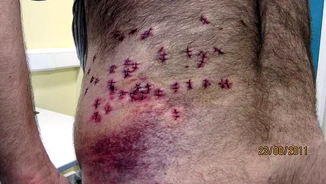 Înjunghiat de 38 de ori, un bărbat a supraviețuit datorită unei boli