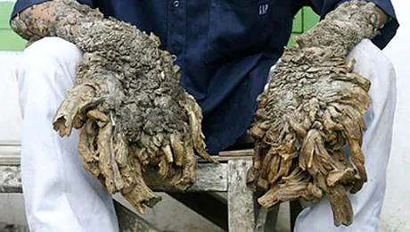 Omul copac exista in Indonezia (Poze)