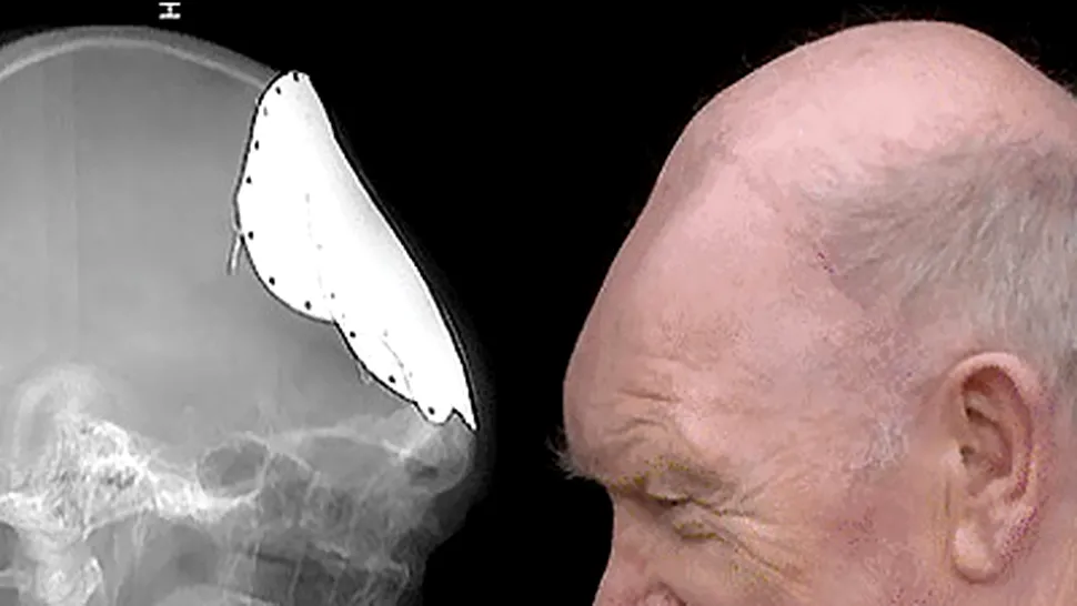 Craniul unui barbat s-a regenerat dupa un accident