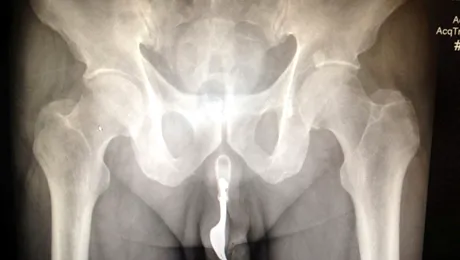 Medicii i-au scos o furculiță din… penis